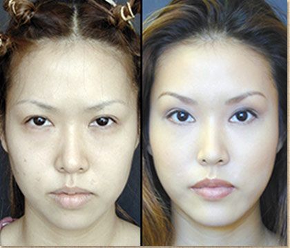 asian Cosmetic eye surgery