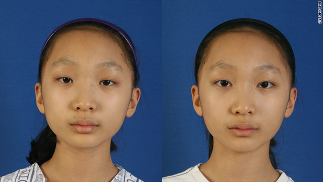 asian Cosmetic eye surgery