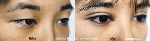 asian Cosmetic eye surgery